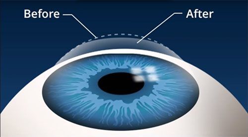 phẫu thuật lasik