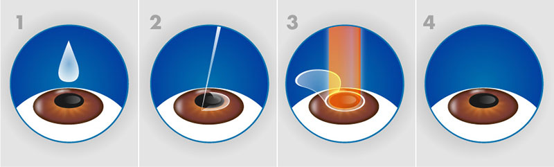 phau-thuat-lasik-3