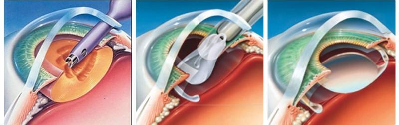 Phẫu thuật phaco trong điều trị đục thuỷ tinh thể – Bệnh Viện Mắt ...