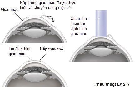 phau-thuat-lasik