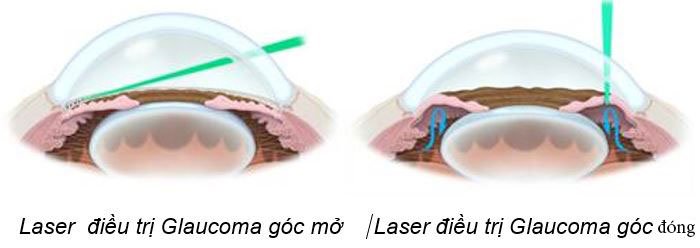 dieu-tri-glaucoma-2