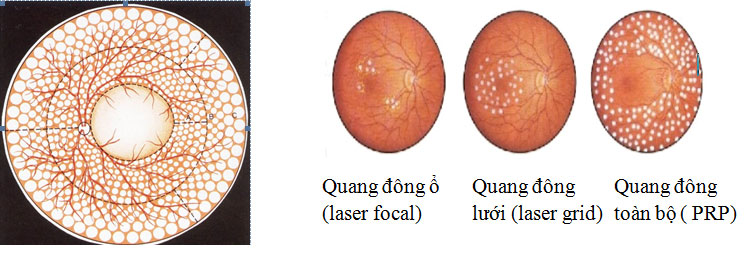 Laser quang đông toàn bộ võng mạc
