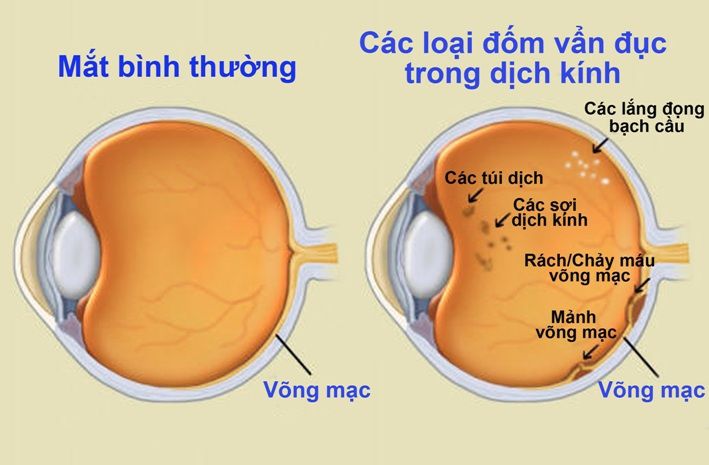 vẩn đục dịch kính