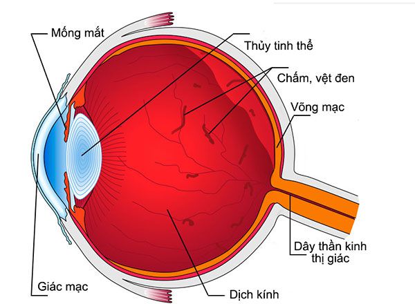 vẩn đục dịch kính