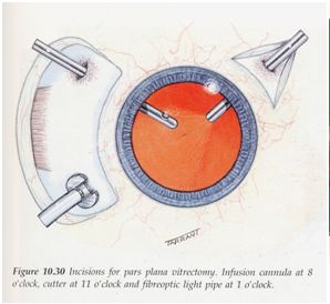 phẫu thuật cắt dịch kính
