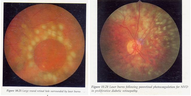 Laser xung quanh vết rách võng mạc và Panretinal Photocoagulation