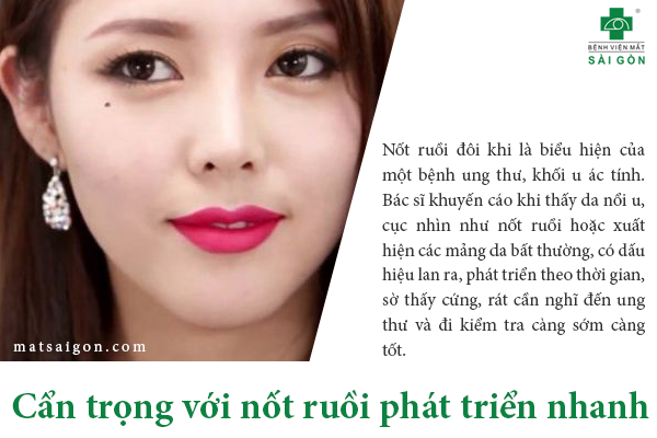 nốt ruồi ở mi mắt