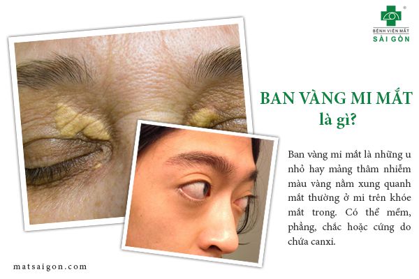 nguyên nhân ban vàng mí mắt