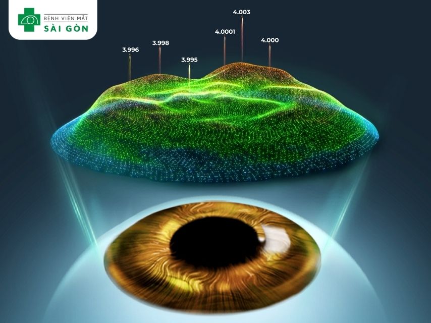 Phẫu thuật LASIK với phương pháp EYESignature