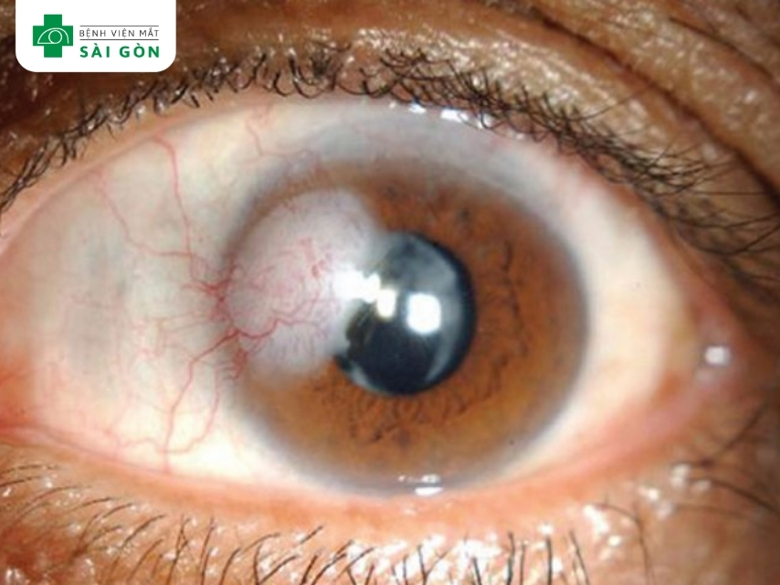 Viêm bờ mi có thể gây đục giác mạc