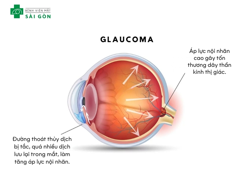 Glôcôm làm mất thị lực vĩnh viễn