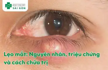 Mắt bị lẹo với khối sưng đỏ ở mí mắt