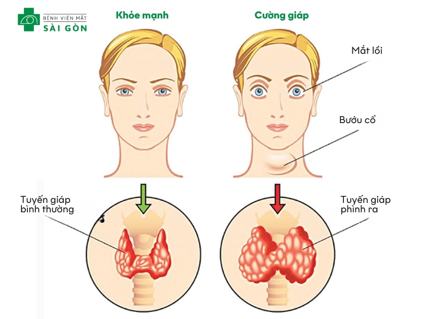 Nguyên nhân bệnh lý gây mắt lồi