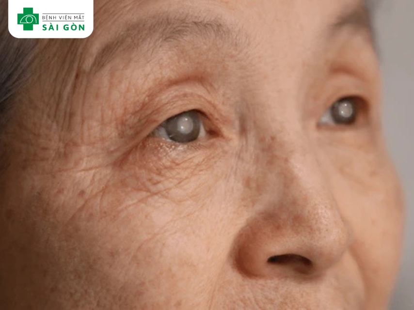 Các bệnh lý sau phẫu thuật ảnh hưởng đồng tử