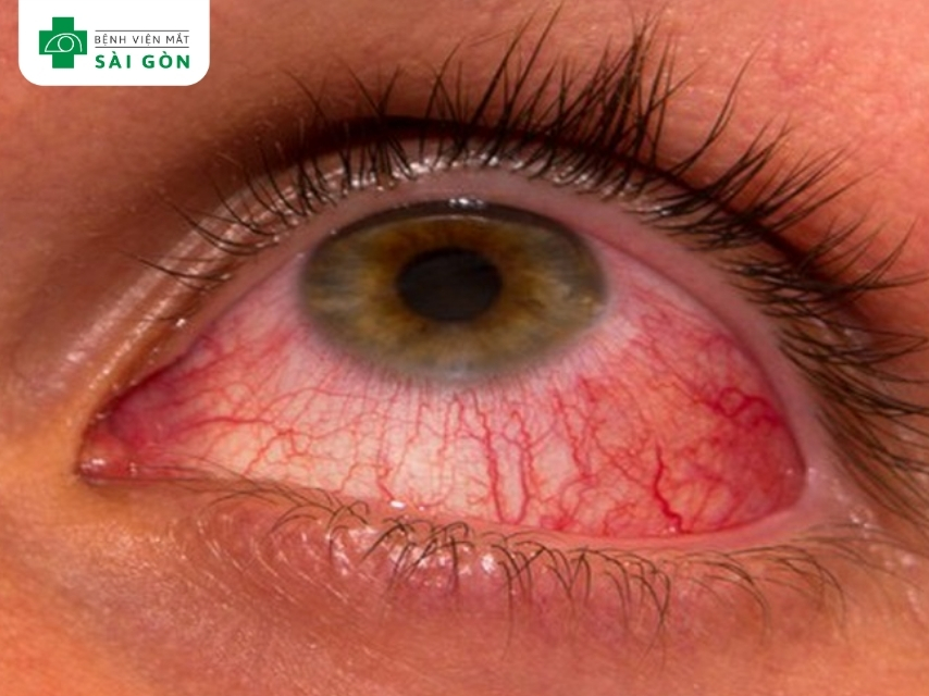 Tình trạng phổ biến của viêm màng bồ đào trước là viêm mống mắt