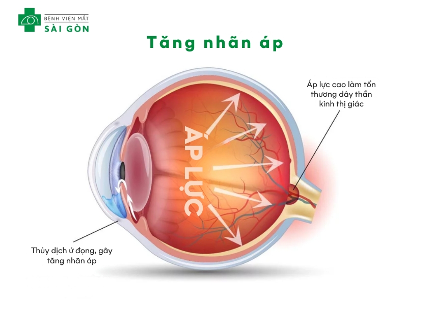 Tăng nhãn áp gây tổn thương thần kinh thị giác do áp lực mắt tăng cao