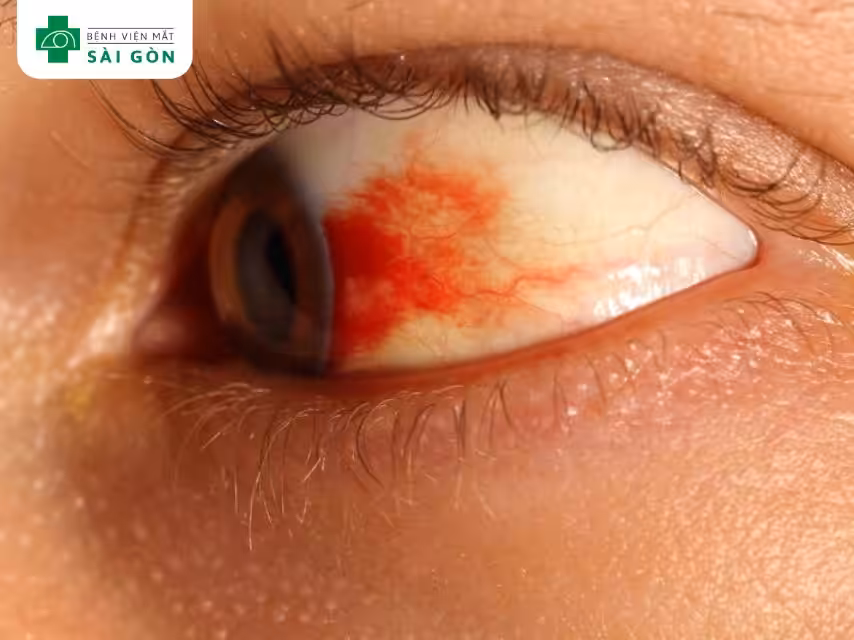 Bong võng mạc, xuất huyết dịch kính