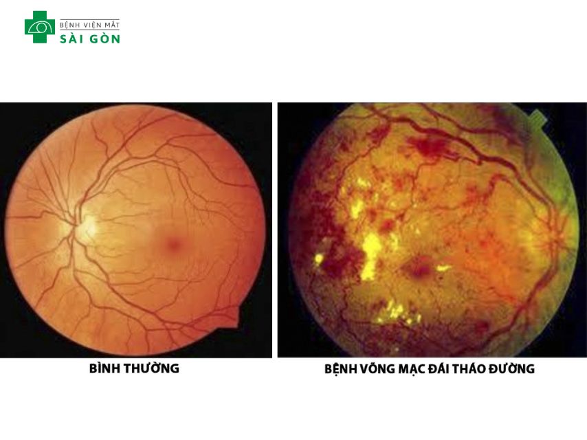 Võng mạc đái tháo đường