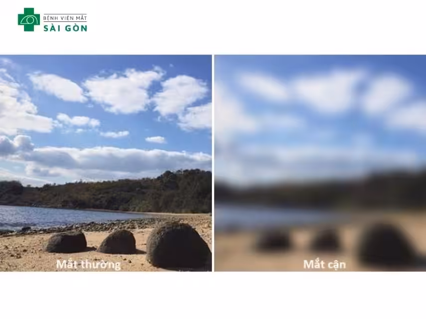 Cận thị 1.5 độ thường biểu hiện qua việc nhìn mờ các vật ở xa trên 1 mét