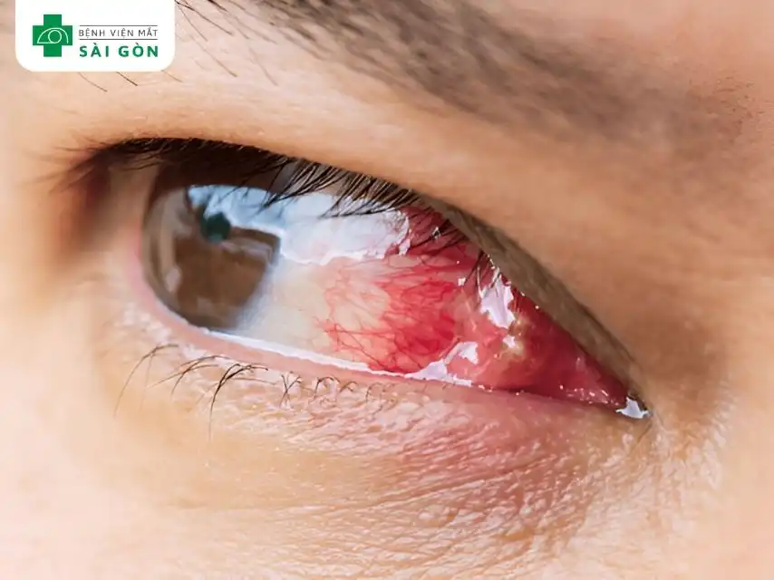 Biểu hiện của Herpes mắt