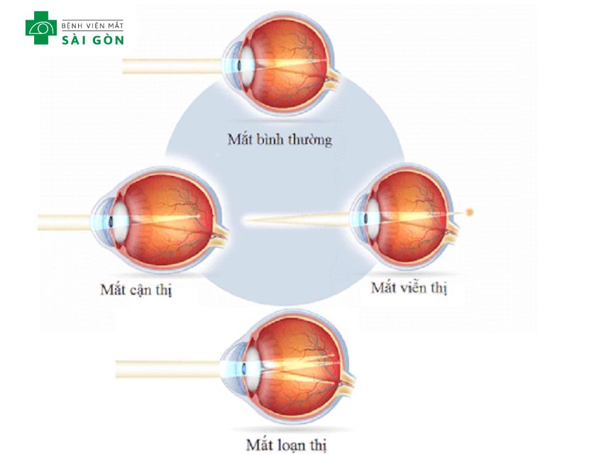 Biểu hiện của nheo mắt