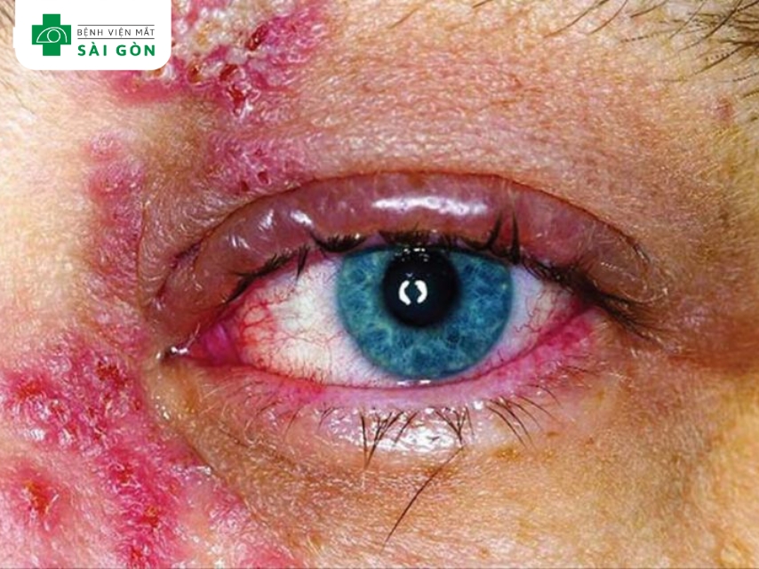 Triệu chứng sớm gồm mắt đỏ và chảy nước mắt