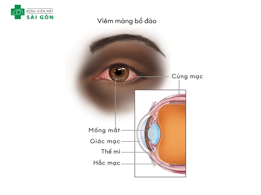 Viêm màng bồ đào làm cho mắt đỏ, đau nhức, sợ ánh sáng
