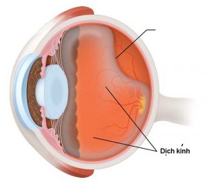 Bong dịch kính: Dấu hiệu và cách điều trị hiệu quả bong dịch kính