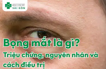 Bọng mắt là tình trạng gì