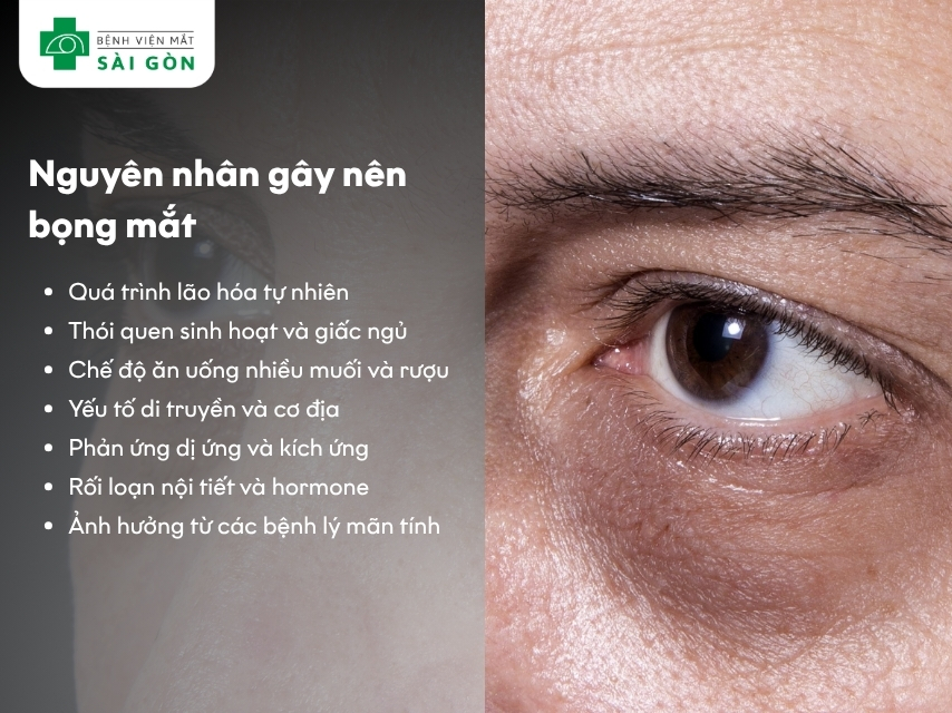 Bọng mắt do nguyên nhân nào