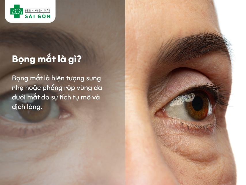 Bọng mắt là tình trạng gì