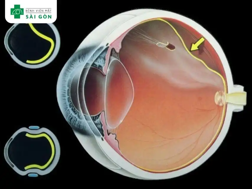 Rách hay bong võng mạc