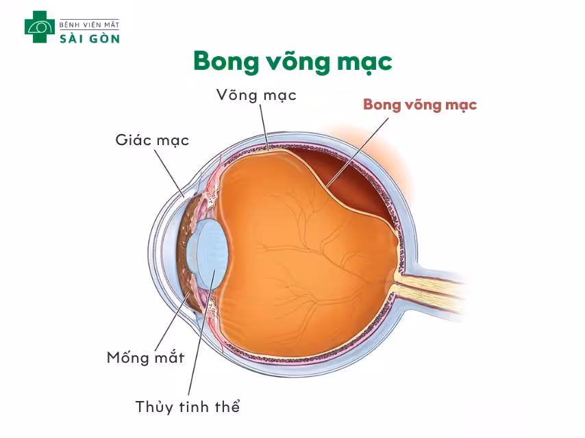 Bong võng mạc là gì