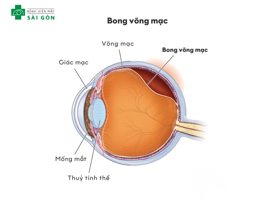 Bong võng mạc mắt