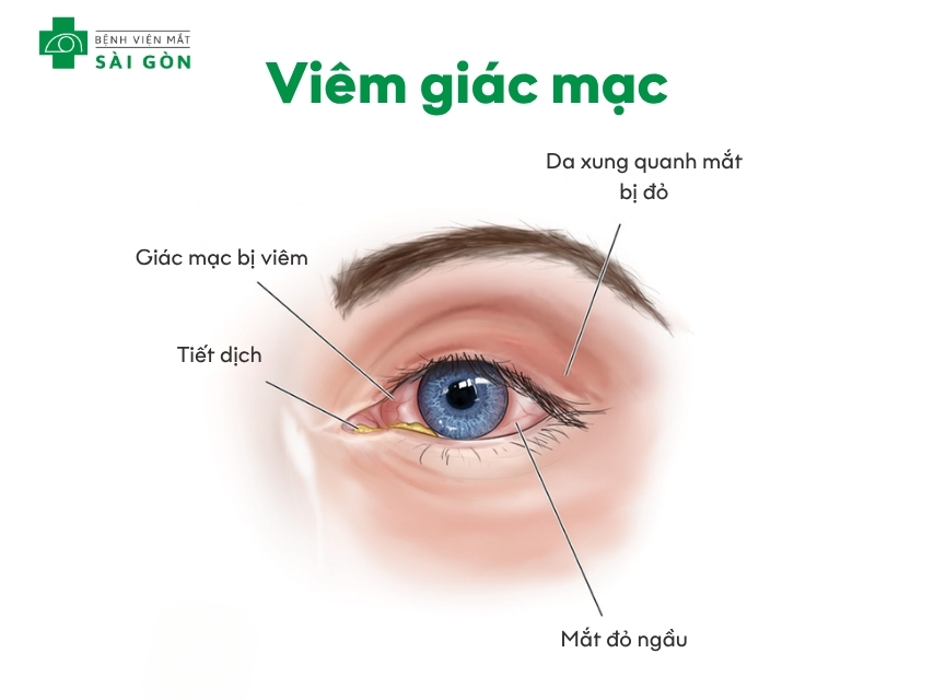 Nhiều bệnh lý ảnh hưởng tổn thương giác mạc