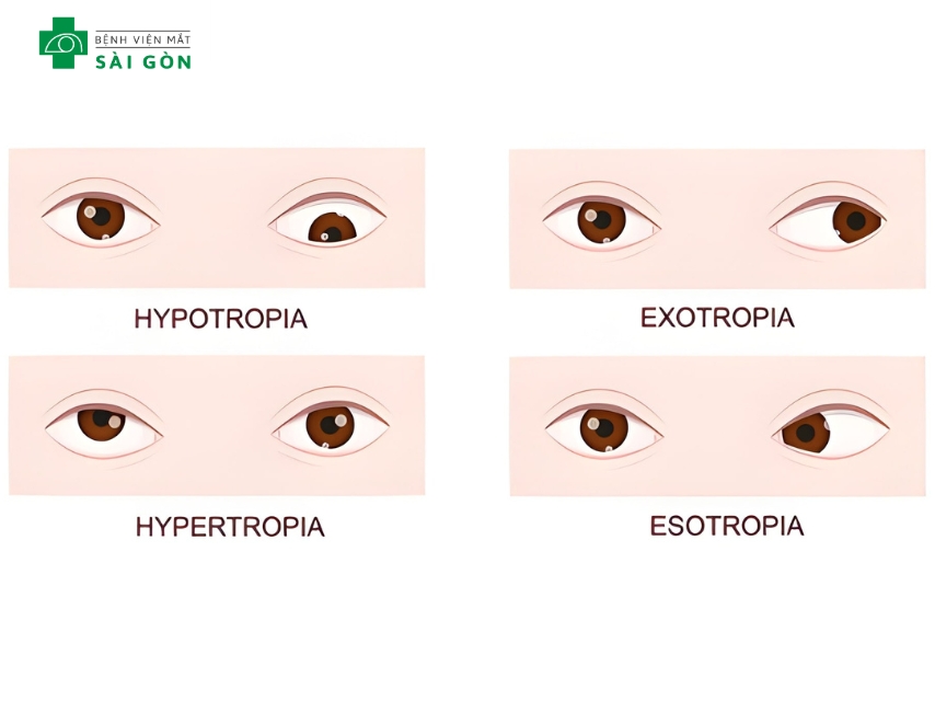 Bốn dạng lé kim chính