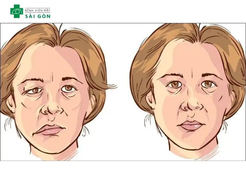 3 giai đoạn chính của phù gai thị