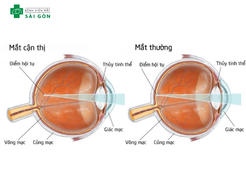 Các loại tật khúc xạ