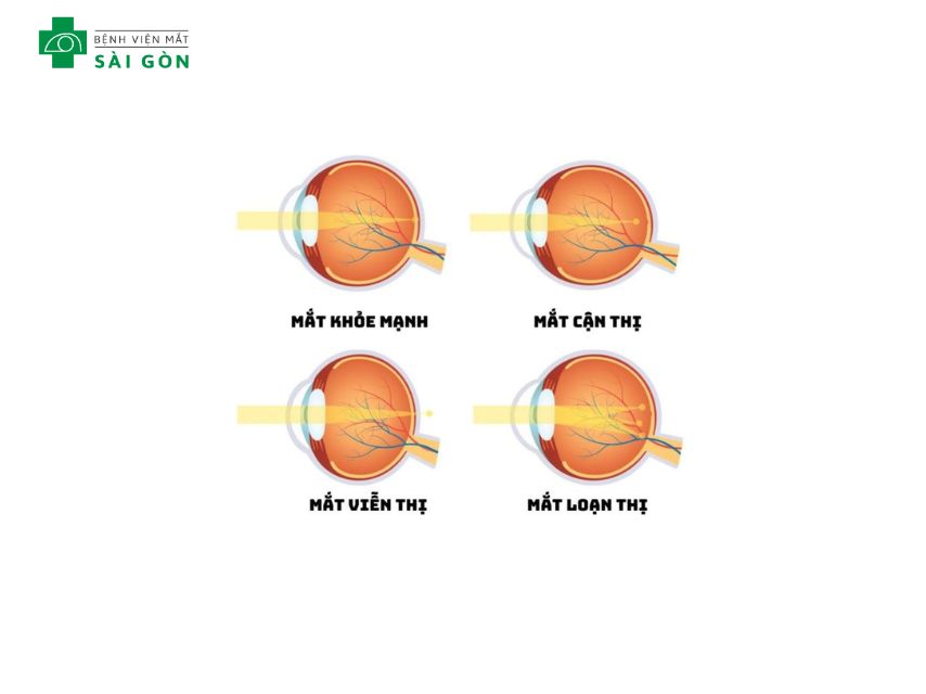 Các tật mắt là gì