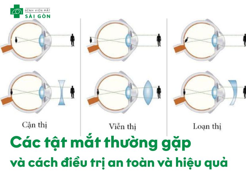 Các tật mắt thường gặp