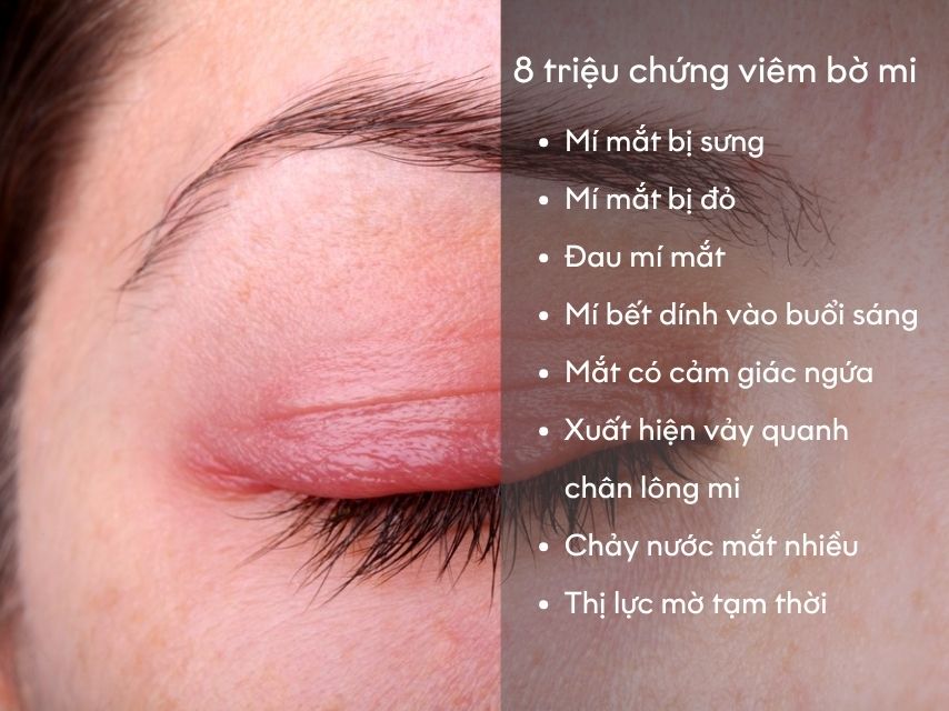 Triệu chứng chủ quan của viêm bờ mi thường bao gồm cảm giác nóng rát và ngứa ở mi mắt hoặc vùng mắt.