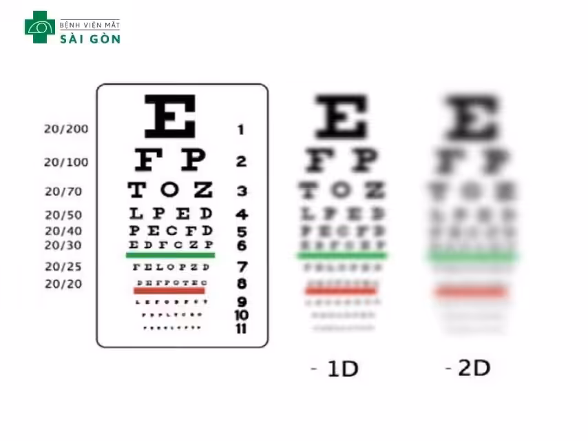 Cận thị 1.5 độ (-1.50 Diop)