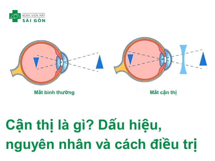 Bệnh mắt cận thị và những thông tin cần biết