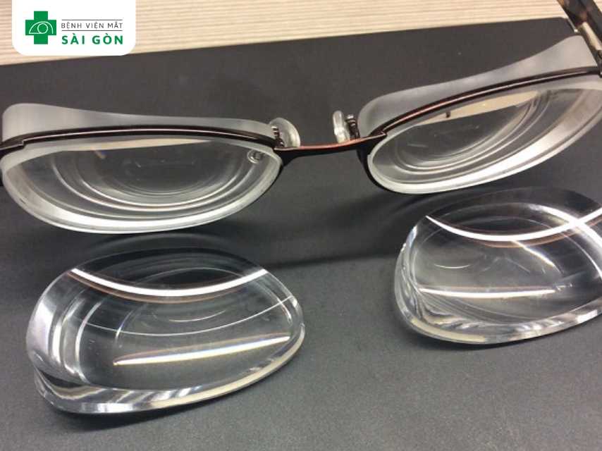 Cận thị nặng ảnh hưởng thời gian phục hồi