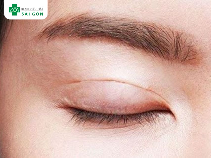 Cắt mí mắt là gì