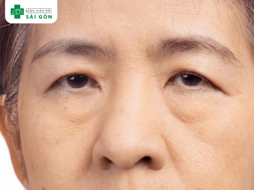 Cắt mí mắt mang lại nhiều lợi ích