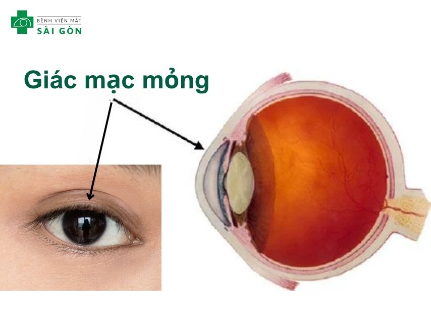 Giác mạc mỏng gây tái cận