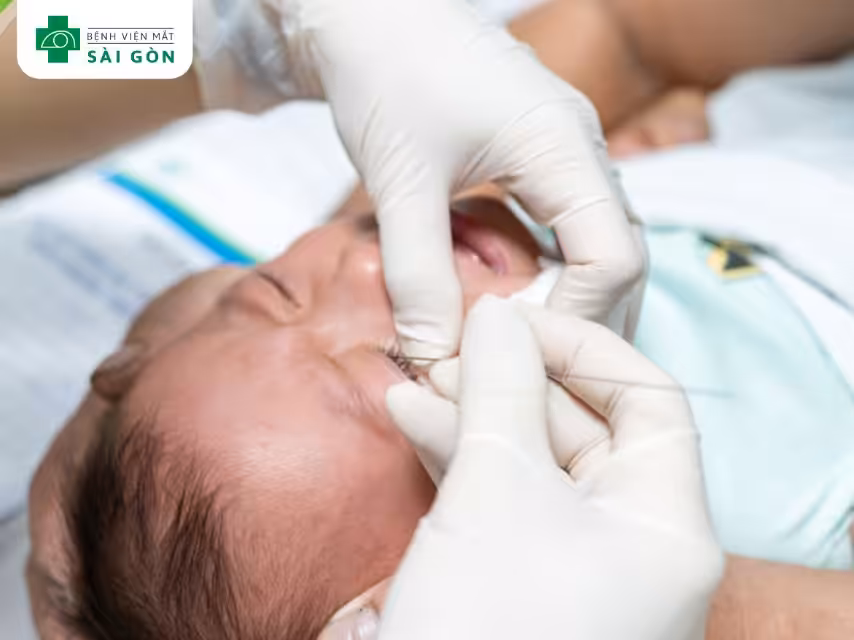 Chẩn đoán tắc tuyến lệ ở trẻ sơ sinh