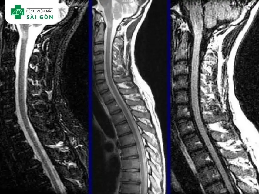 Chụp MRI cột sống cổ-ngực