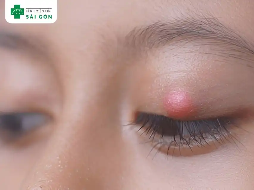 Lẹo mắt là tình trạng viêm hoặc nhiễm trùng ở gốc lông mi